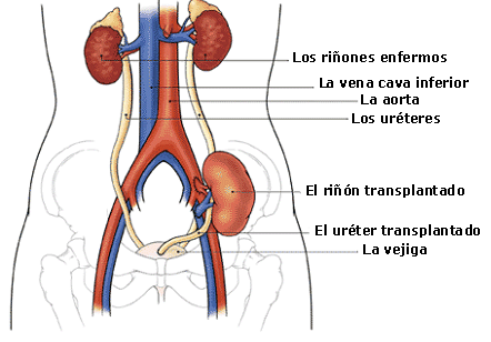 transplante